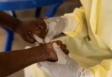 Vacina brasileira contra a mpox está próxima dos testes em humanos