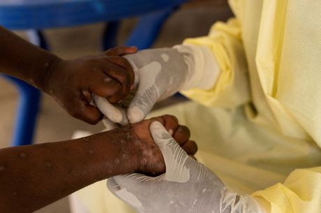 África declara emergência em saúde pública por epidemia de mpox